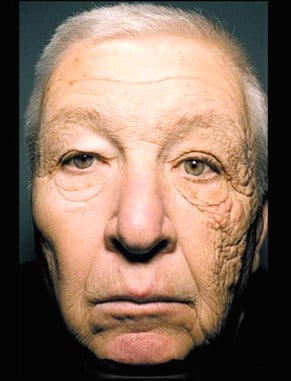 Ageing skin